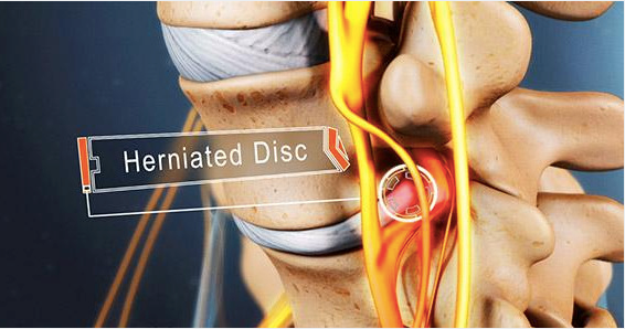您的腰间盘突出什么时候需要手术？